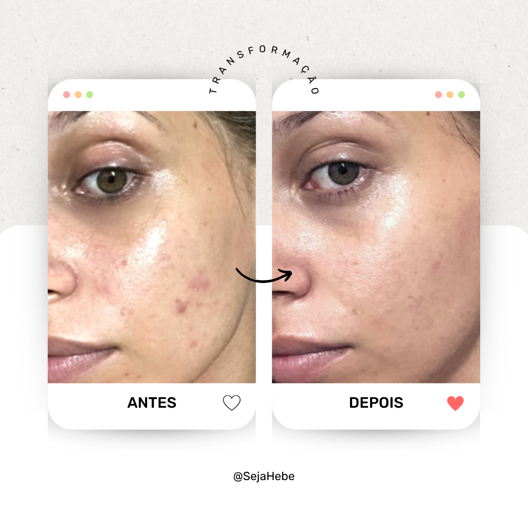 Kit Pele Lisinha - 3 Produtos Contra Acne Adulta